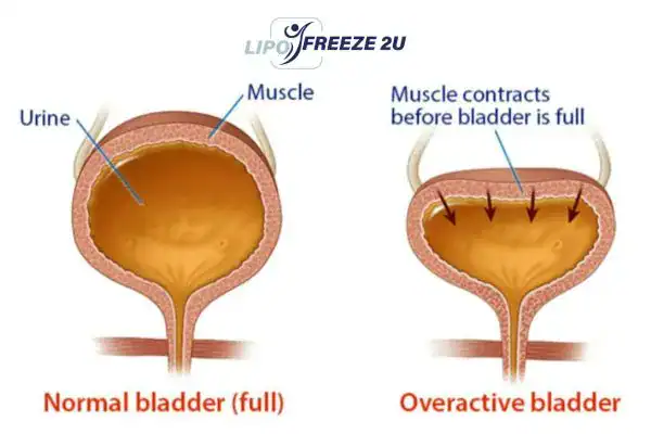 diagram of overactive bladder treatment Sheffield