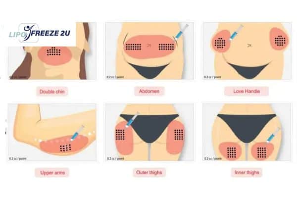 Benefits of Choosing Aqualyx for Fat Reduction Sheffield