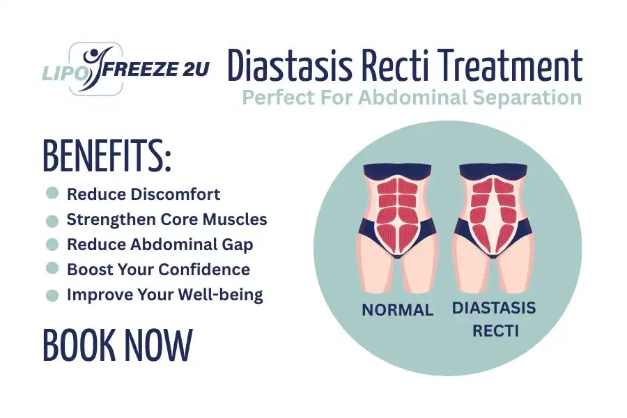 Benefits of body toning treatment Sheffield for Diastasis recti