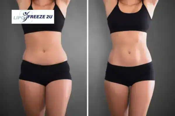 How Can LIPO FREEZE 2U Support Your Post-Pregnancy Body Recovery Sheffield?