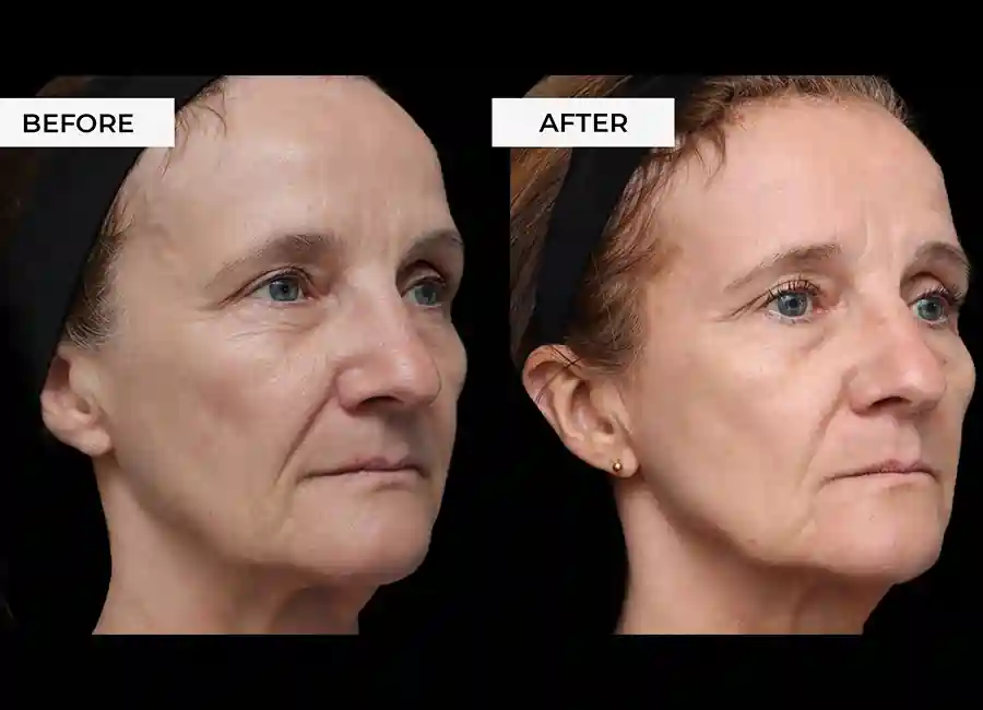 How Many RF Microneedling Sessions Will You Need to See a Difference Sheffield?