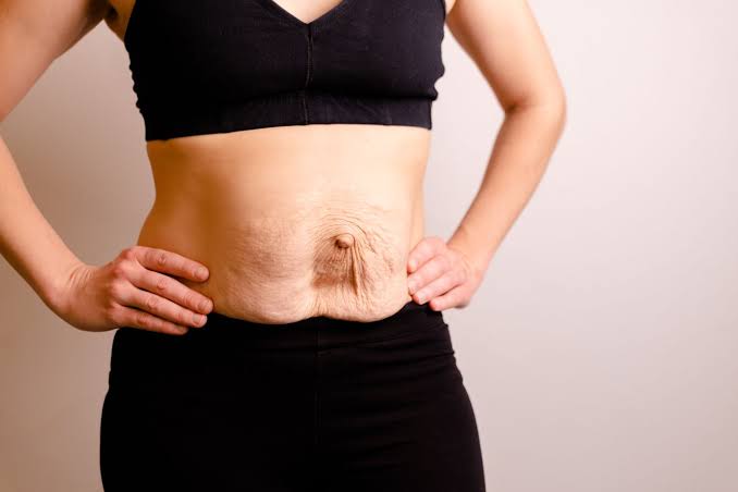 Is Surgery Really the Only Way to Repair Diastasis Recti Sheffield?