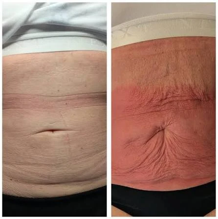 How Does RF Microneedling Improve Crepey, Thin and Uneven Skin Texture Sheffield?