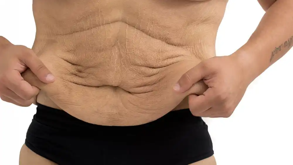 Why Does Weight Loss Medication Leave Some People With Loose or Sagging Skin Sheffield?